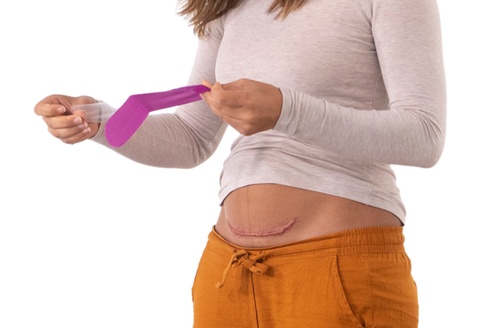 Silicone C-section scar treatment