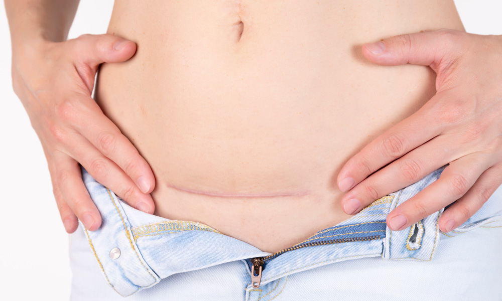 C-Section scar