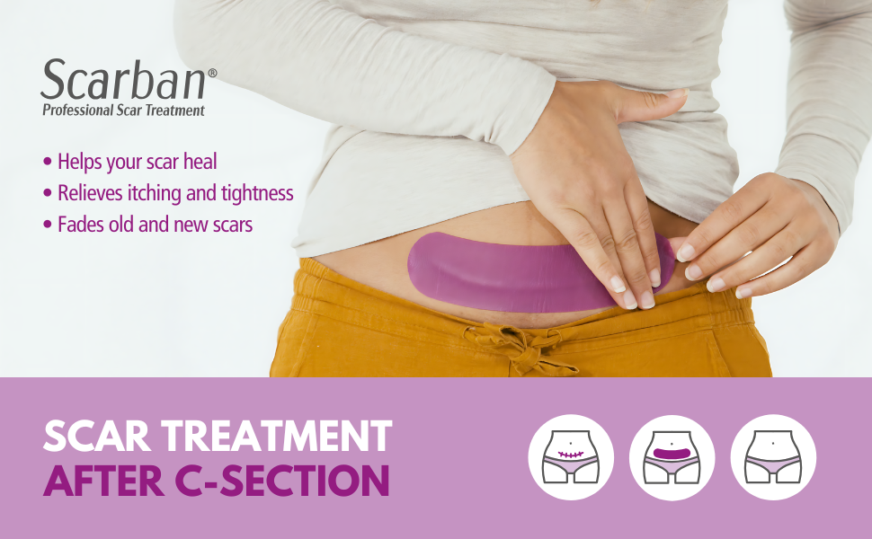 Scarban C-Section scar treatment