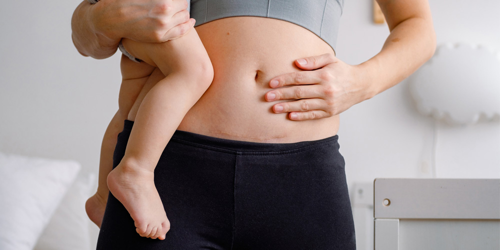 Women with C-section scar holding her baby