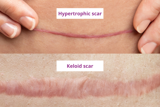 Hypertrophic and keloid scar