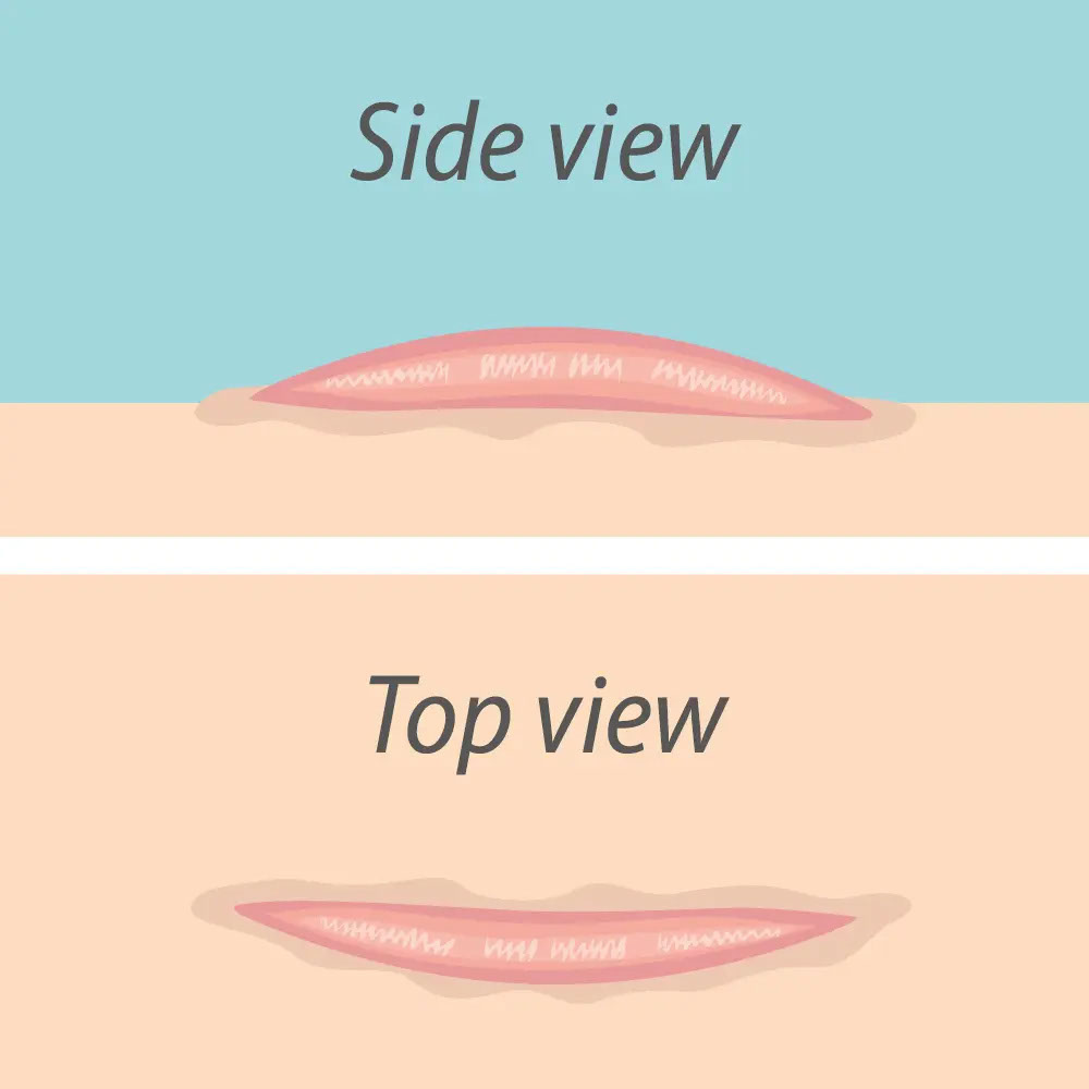 Hypertrophic scar illustration - side view and top view