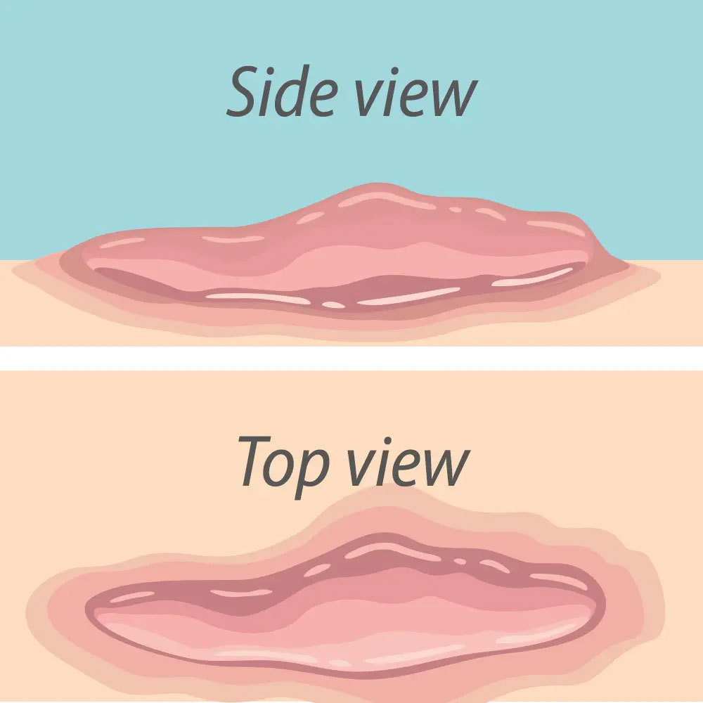 Keloid scar illustration - side view and top view